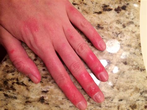 red swollen fingers one year and no diagnosis skin symptoms