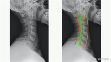 cervical spine  ray interpretation osce guide geeky medics