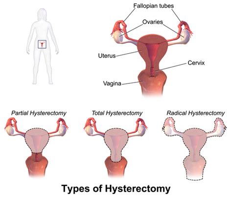 Endometrial Hyperplasia — Diagnosis And Treatment Medical Library