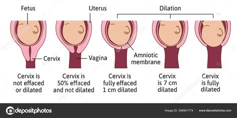 cervical effacement  dilation  labor  delivery cervix