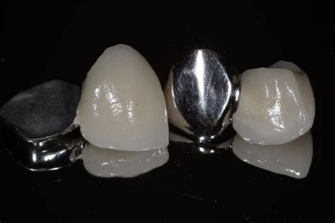 single tooth replacement options resin bonded bridgesshould  stick     key