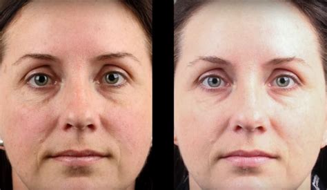 How Freckle Removal Treatments Can Enhance Your Natural Appearance