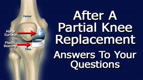 after partial knee replacement surgery answers to your questions youtube