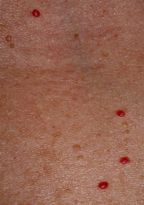 tiny red blood spots  skin red spots  legs itchy pictures dots