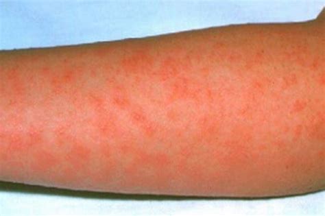 Red Alert As Scarlet Fever Cases Continue To Rise Hinckley Times