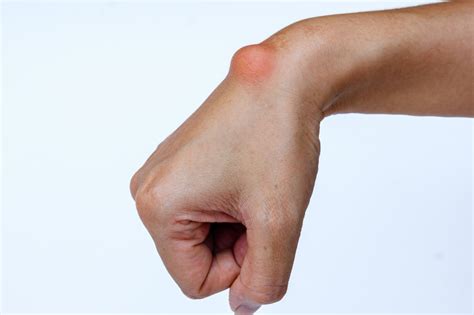 common wrist injuries  family physio