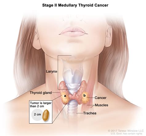 Thyroid Cancer Treatment Adult Pdq® Patient Version National