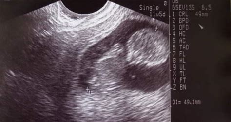 anomaly scan    posterior placenta
