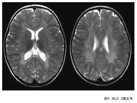 clinical diagnosis  patients  cerebral white matter abnormalities