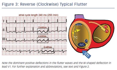 figure 3 reverse clockwise typical flutter radcliffecardiology