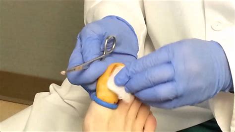 ingrown toenail removal  podiatrist youtube