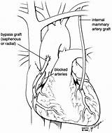 Surgery Bypass Coronary Artery Cabg Pump Off Circulation Patients Powerpoint Figure Ahajournals sketch template