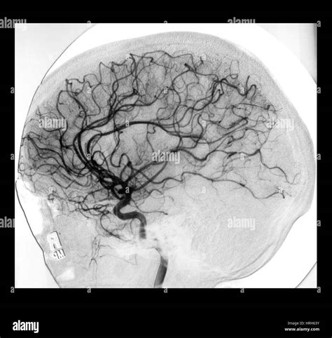 zerebrale angiographie stockfoto bild  alamy