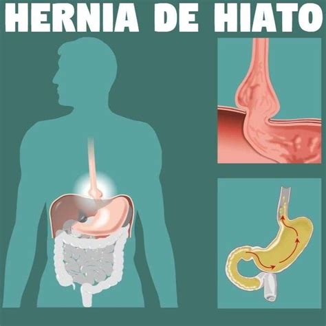 ¿qué síntomas tiene la hernia de hiato herbolario saber y vida