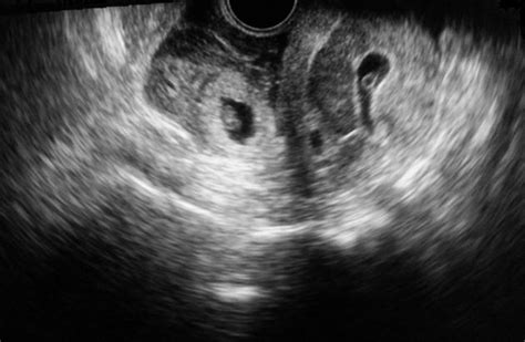 A Rare Case Of Heterotopic Pregnancy Managed By Laparoscopic