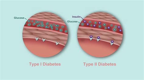 difference  type  type  diabetes chart chart walls