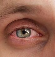 Image result for conjuntival. Size: 177 x 185. Source: www.clinicabaviera.com