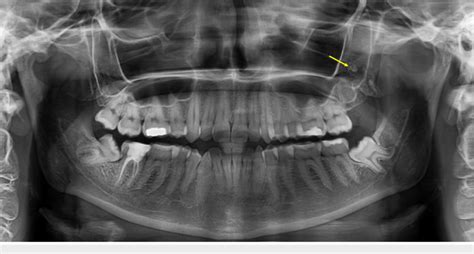 Antrolith Within The Left Maxillary Sinus A Panoramic Radiograph