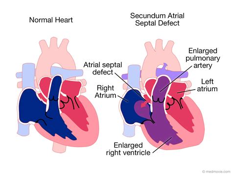 pin  nonas arc  atrial septal defect asd atrial septal defect normal heart arteries