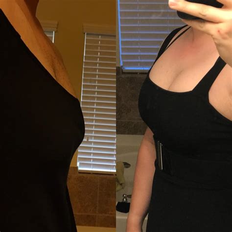 [mtf] Breast Growth At 2 Months And 7 Months R Transtimelines