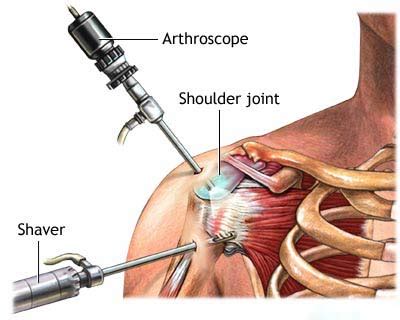 arthroscopy arthroscopic  keyhole surgery  singapore singapore sports  orthopaedic clinic