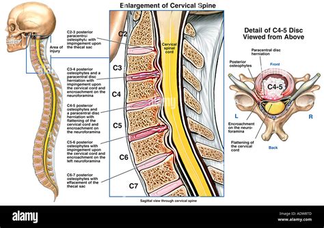 spinal cord injury bandscheibenvorfall bandscheibenvorfall festplatte stockfoto bild