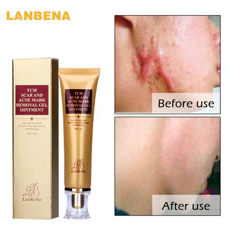 lanbena acne scar removal cream skin repair face cream acne spots