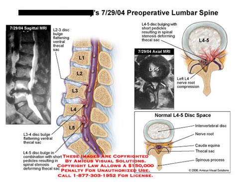 preoperative lumbar spine
