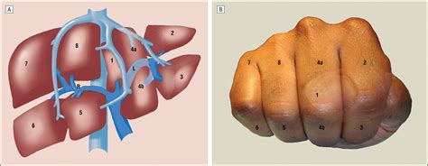 A Handy Tool To Teach Segmental Liver Anatomy To Surgical Trainees
