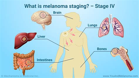 slide show understanding melanoma