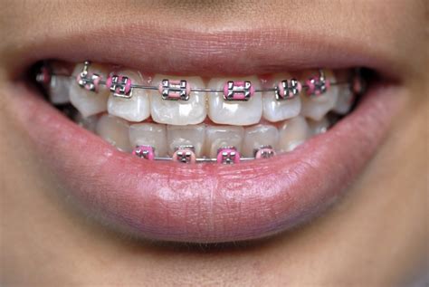 coloured braces guildford orthodontics surrey bc