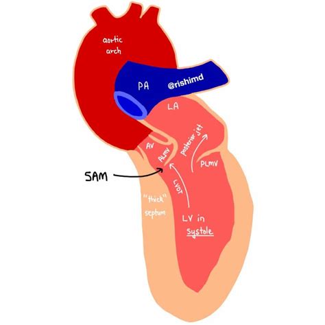 systolic anterior motion sam   mitral valve left ventricular outflow tract lvot