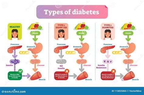 types  diabetes simple medical vector illustration scheme health care information diagram