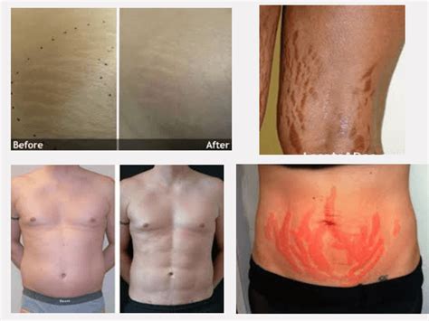 laser stretch mark removal the advanced way of removing