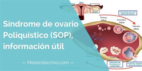 Síndrome De Ovario Poliquístico La Primera Causa De Infertilidad Femenina