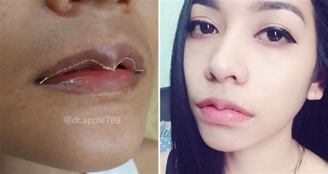 crazy new plastic surgery trend among asian women amped asia magazine