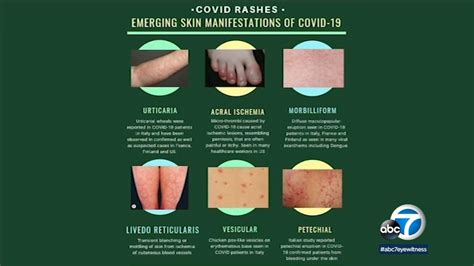 coronavirus los angeles dermatology organization issues guidance  skin rashes