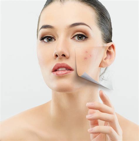 three ways to get rid of acne scars northcoast laser cosmetics llc
