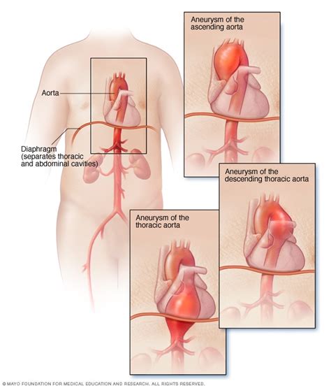 thoracic aortic aneurysm symptoms   mayo clinic