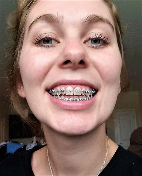 Cute Girl Braces For Teeth – Telegraph