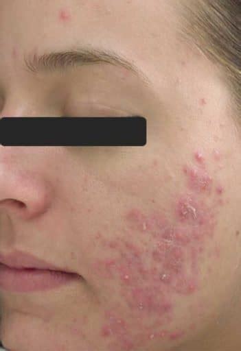 Best Acne Treatment For Adults And Teens In Scottsdale Az
