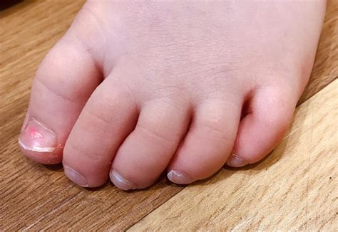 curly toes… [adductovarus deformity of the 4th or 5th toe] care for feet