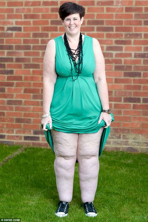 obese mother is left with tree trunk legs due to rare