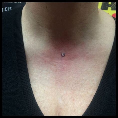 Pin On Microdermals