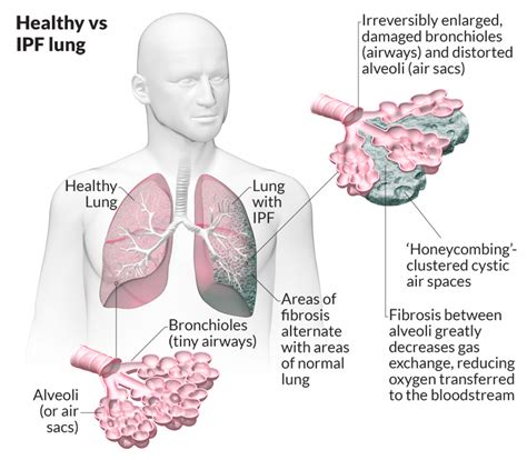 Ajit Vadakayil Interstitial Lung Disease Nano Carbon Emissions Cng