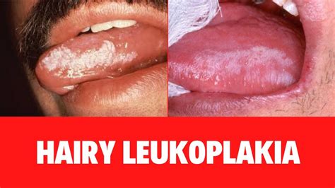 What Is Hairy Leukoplakia Oral Hairy Leukoplakia Symptoms Causes