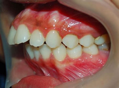 tipos de mordida protrusion clinica dental casaus