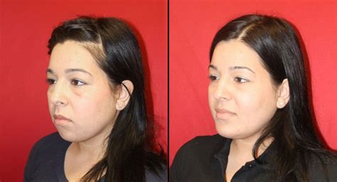 chin enhancement chin implant cosmetic surgery chin