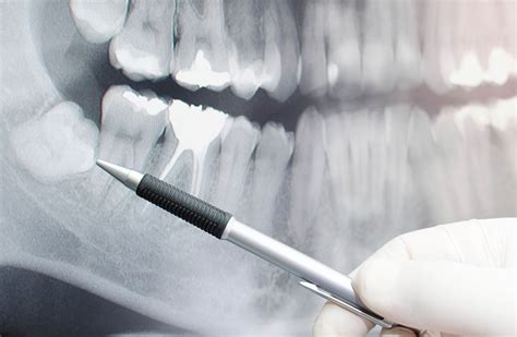impacted wisdom teeth  symptoms  treatment options