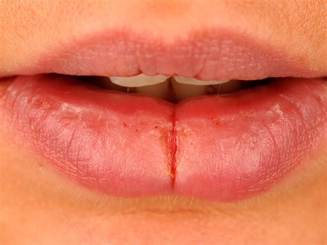 chronische fissuur van de lip chronic median lip fissure